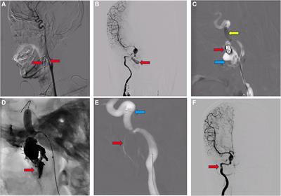 Case report: Endovascular intervention of internal carotid artery pseudoaneurysm secondary to nasopharyngeal carcinoma radiotherapy
